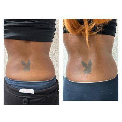 Skin tightening during a Lipo360 session