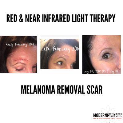 Lisa's scar is hardly noticeable! RLT is clinically proven to reduce wrinkles, fine lines, skin damage & scarring.