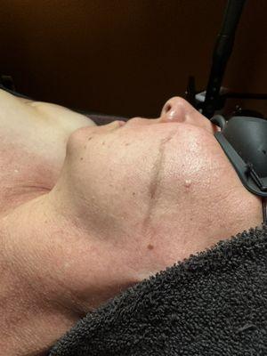 Dermaplane facial