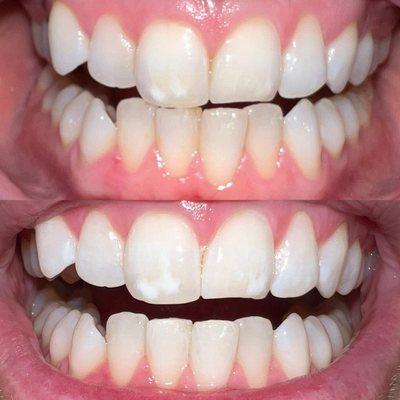 Real People, Real Results. (Calcium Deposits)