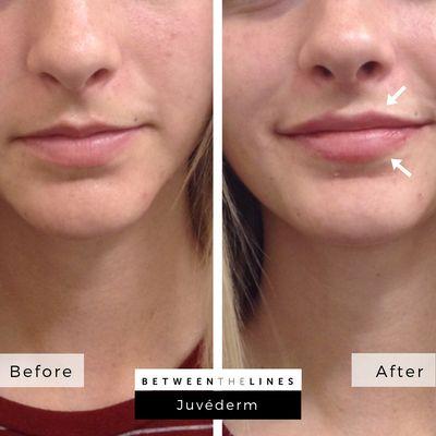 Before and after Juvéderm in lips for a subtle and natural, yet noticeable difference.