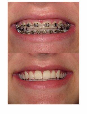 Before and after crown lengthening with Dr. Williamson