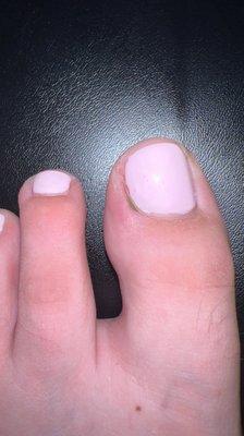 toe fungus!!!!!!!