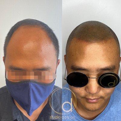 Scalp Micropigmentation at Studio Dotz On