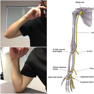 Cubital Tunnel Syndrome is a condition that involves pressure of the ulnar nerve at the elbow. Call (310)-652-6060 for questions!