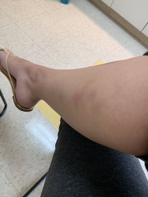 Bruised right inner leg