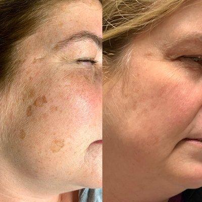 Photofacial IPl Treatment Pre & Post