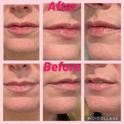 Juvederm lip filler