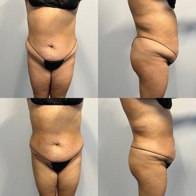 1 session of body contouring