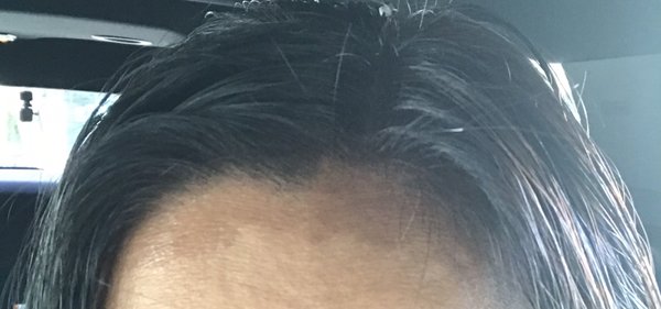 More dye along my hairline on my forehead.