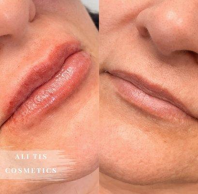 Hyaluron pen lip filler before & after