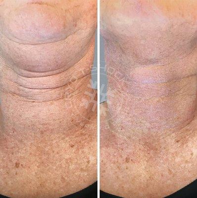 Before and after photo of cryotherapy client