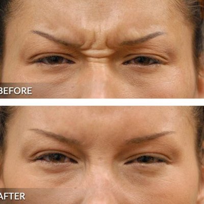 Botox alleviates frown lines between eyebrows.