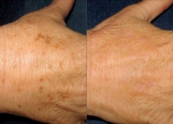 Laser hand treatment