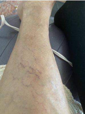 Varicose veins