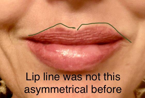 Green line added to emphasize the differently shaped sides of my top lip. Gaps in liner show on left side.