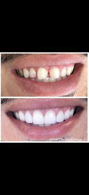 Cosmetic Dentistry with huge transformation with porcelain veneers to greatly improve confidence!