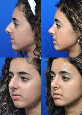 This is a rhinoplasty ("nose job") patient, treated at Garcia Facial Plastic Surgery.