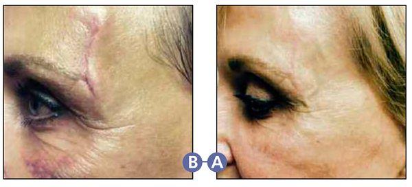 Laser Scar Treatment