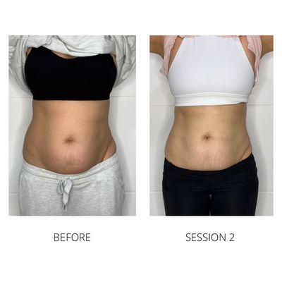 Body Sculpting results after two treatments