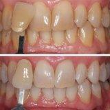 Before and After whitening with Zoom chairside.