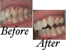 Here is an example of the composite fillings (tooth colored fillings) that we perform on a daily basis.