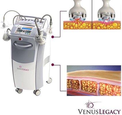 Venus Legacy is the only Device FDA cleared with radio frequency and advanced 4D technologies