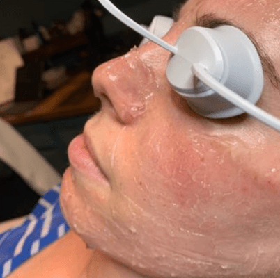 Microdermabrasion, chemical peels, anti aging treatments