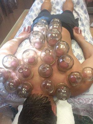 Cupping