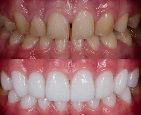 Eeefy 305 Smile with porcelain veneers.