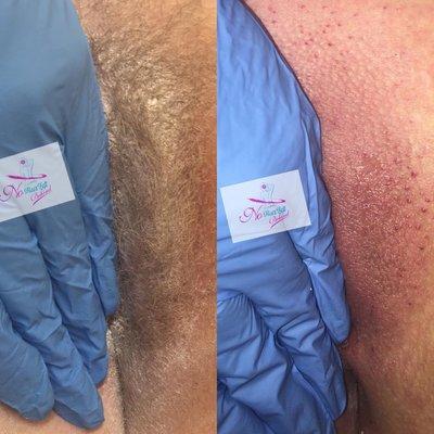 This is before and after EXCLUSIVE & RAW photo of a FIRST TIME BRAZILIAN WAX. You cant this out w/ a razor!