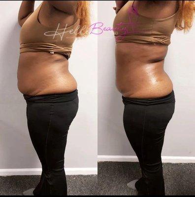 Before and after a Lipo Cavitation session.  Same day results!