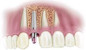 Dental Implants incl. crown with in 2 appointments for $1995.00