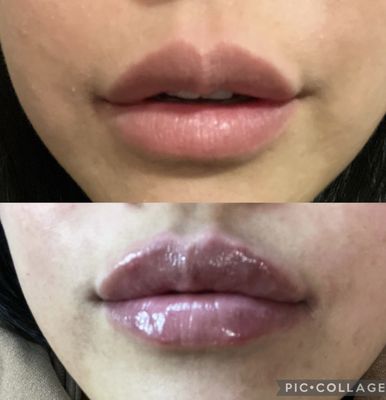 Lip filler to enhance the lips