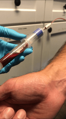 Platelet-Rich Plasma Injection. Step one: Blood is drawn from the patient.