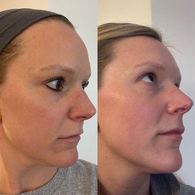 VI Peel Advanced Before & After