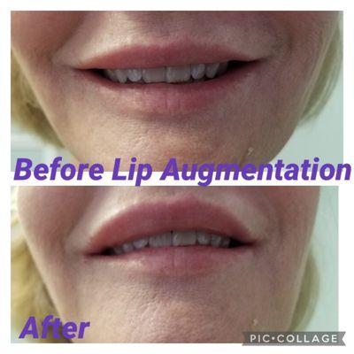 Restylane lip augmentation