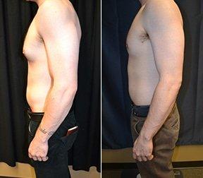 Gynecomastia (male breast reduction)