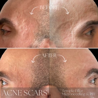 Microneedling with PRF and Dermal Filler in Phoenixville, PA to treat acne scars.