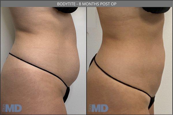 BodyTite by Dr. Ko