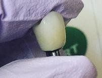 Dental Crown designed with CEREC Technology to restore an implant