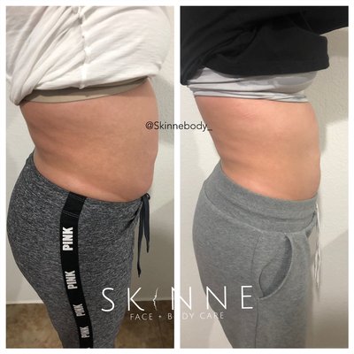 Before and After Ultrasound Cavitation Fat reduction