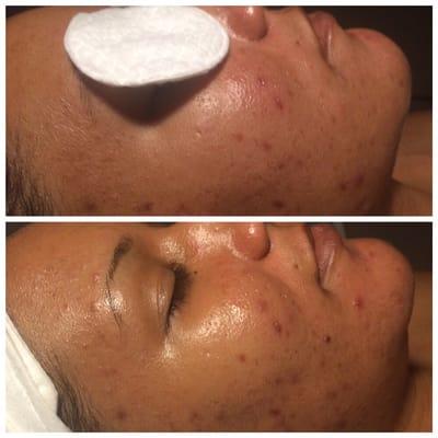 We can help you clear acne and hyperpigmentation . We use Face Reality, it has a 95% success rate in clearing acne.