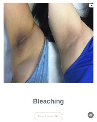 Skin Bleaching / Lightening Skin Brightening