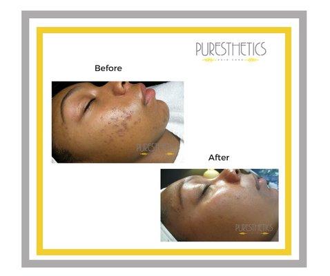 Brown Skin needs to be treated gently to avoid scaring and Hyperpigmentation. Puresthetics Acne Bootcamp will clear your acne for good!