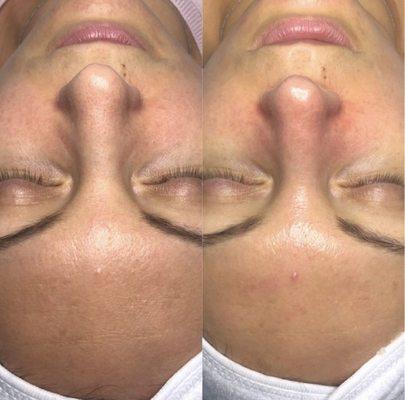 Deep pore clarifying facial