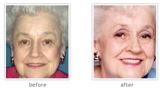 Dr. Jayne can restore worn teeth and replace missing teeth, giving patients back function, appearance & confidence.