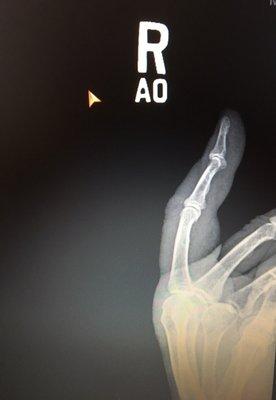 Injured right index finger