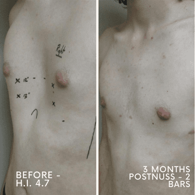 Before & After successful Nuss Procedure 3 months post op, 2 bars.