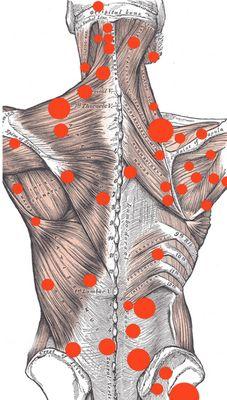 Trigger Point Therapy